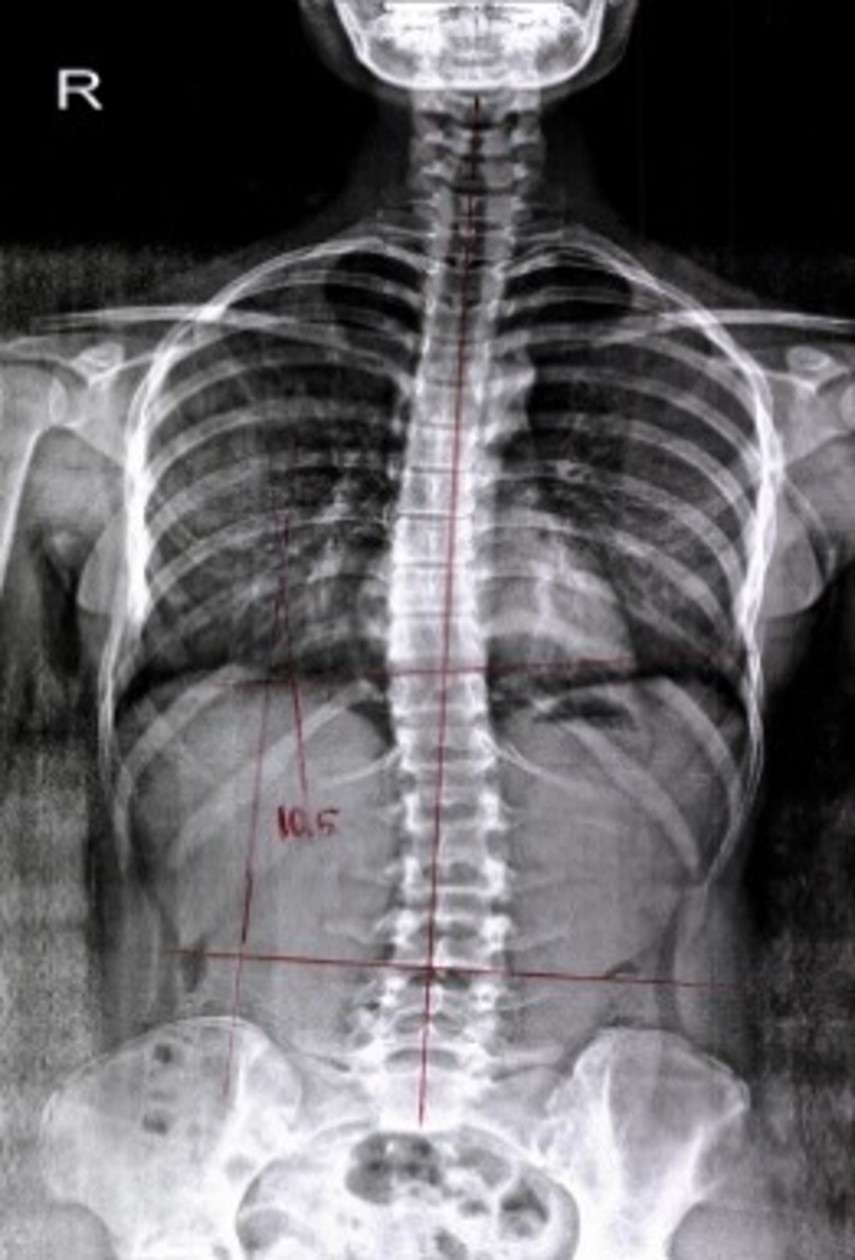 교정 후 X-ray
